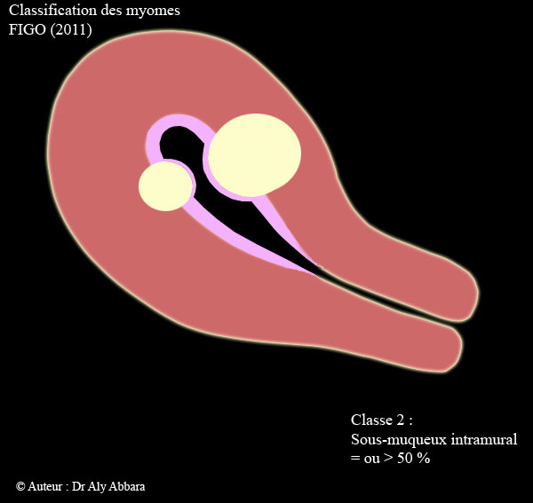 Myomes classe 2
