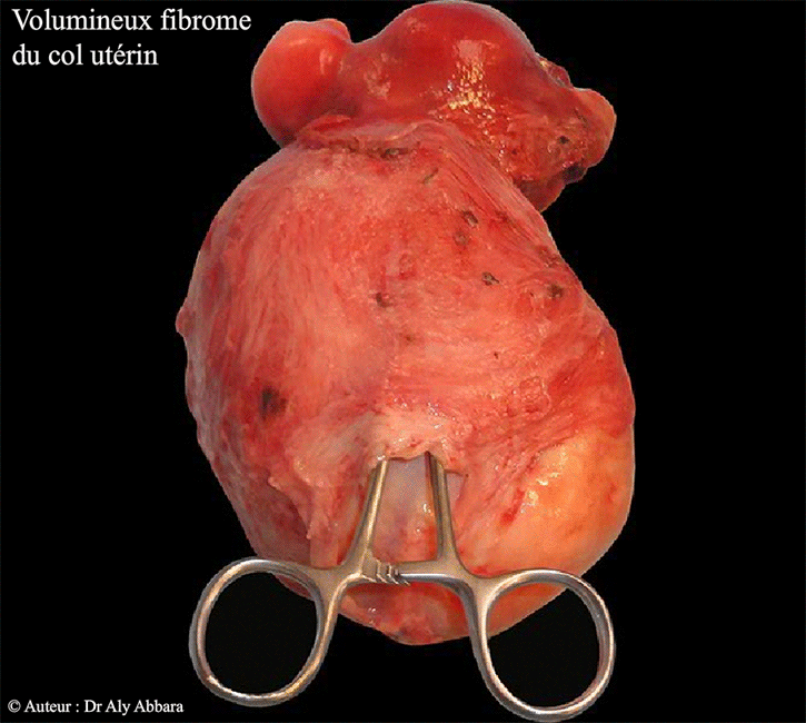 Utérus polymyomateux avec un volumineux myome cervical - Image clinique - Cervix et son myome