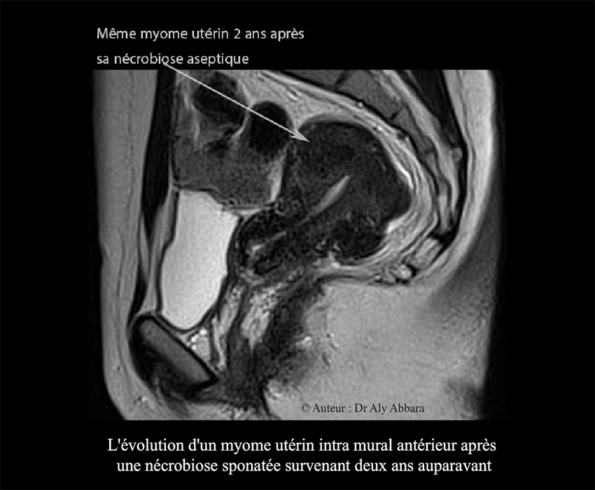 Myome utérin - son aspect après deux de sa nécrobiose aseptique - quasi disparition