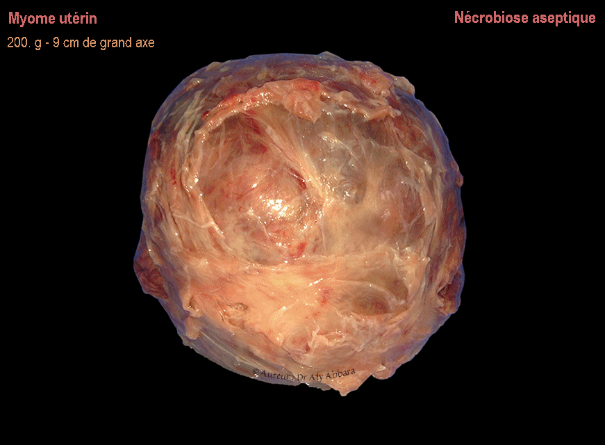 Fibrome utérin en état de nécrobiose aseptique - image clinique de la pièce opératoire
