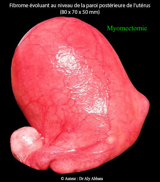 Myomectomie (ablation de myome) par laparotomie