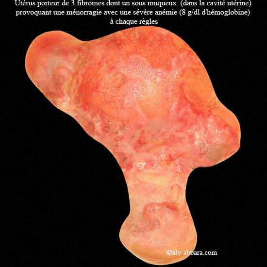 Utérus polymyomateux - Images cliniques