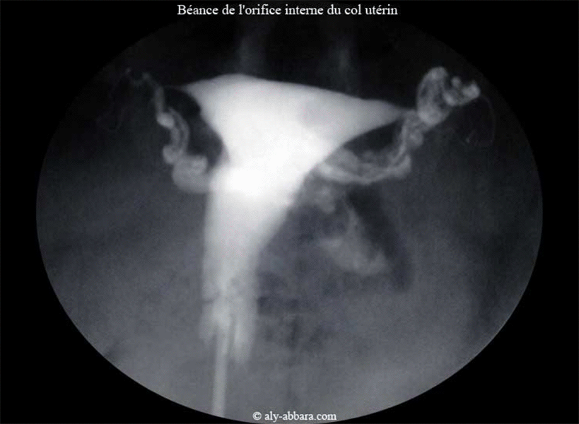 Incompétence de l'orifice interne du col utérin - Aspect du col par hystérographie (HSG)